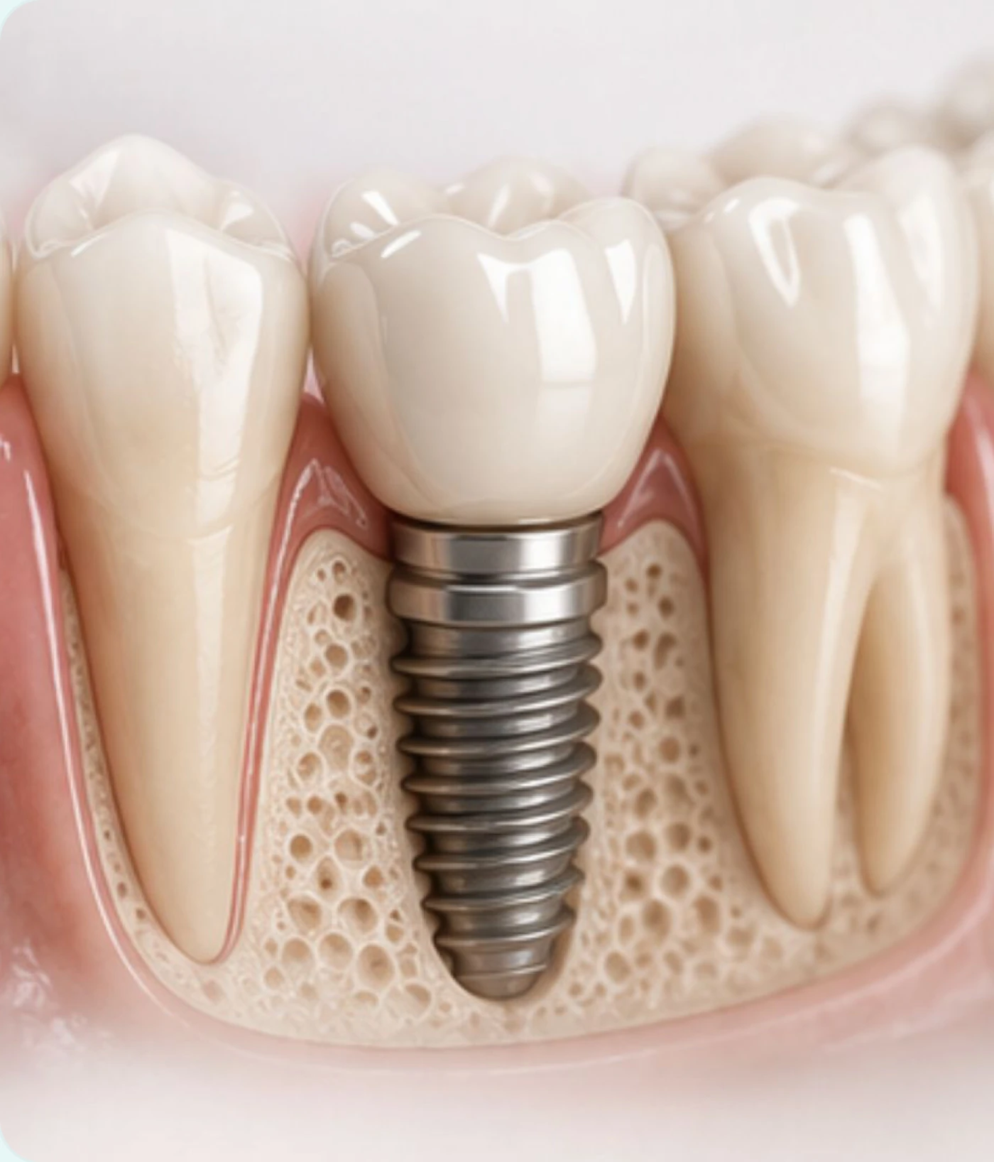 Implantat mit Krone